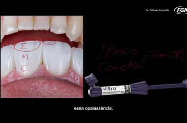 DicasDeConsultorio-Estratificacao-em-resina-composta-com-Vittra-APS