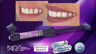 VITTRA-APS-HIGH-STRENGTH-AND-ESTHETIC-COMPOSITE