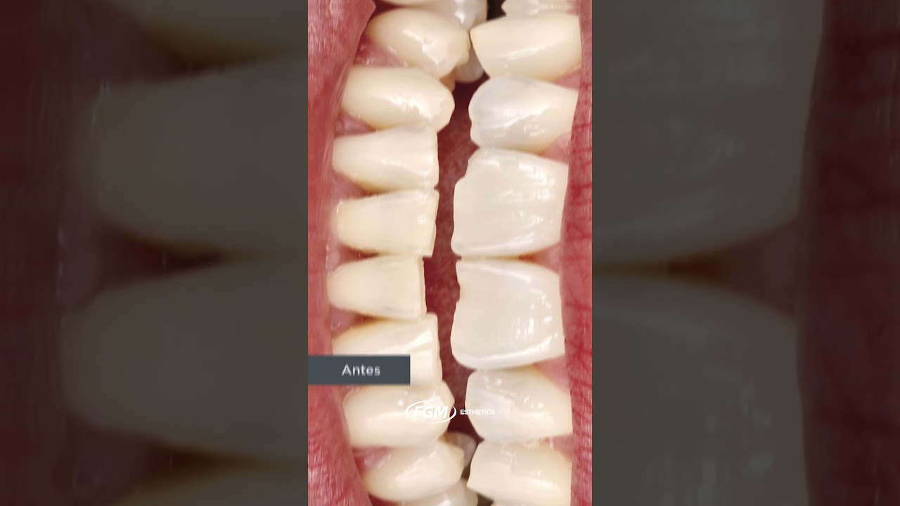 Vittra APS Unique: a solução perfeita para restaurações estéticas em dentes anteriores e posteriores